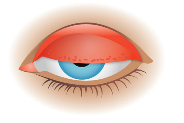 Clinical Contact Lens Management Guide clinical-contact-lens-management-guide